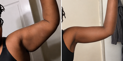 Slimova™ DermaTherm Arm Sleeve