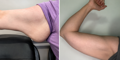 Slimova™ DermaTherm Arm Sleeve