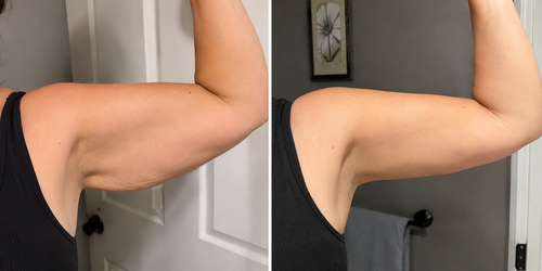 Slimova™ DermaTherm Arm Sleeve